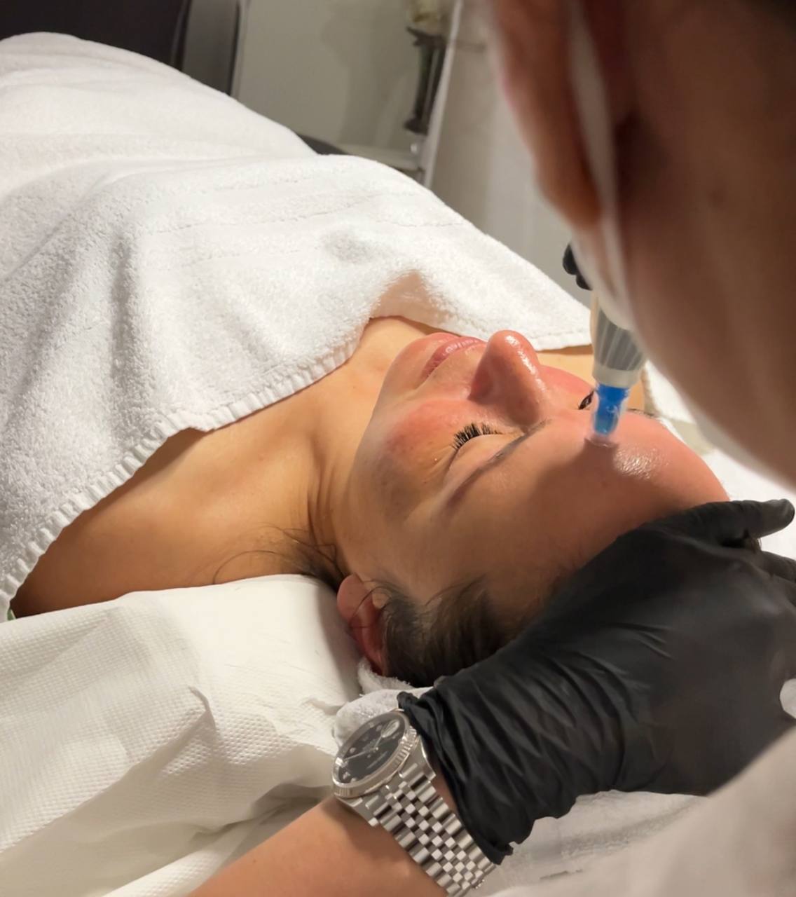 Microneedling (metodo Marie)