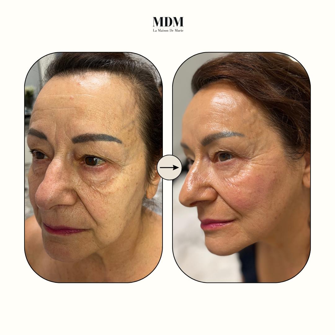 Peeling viso Enzimatico (metodo Marie)