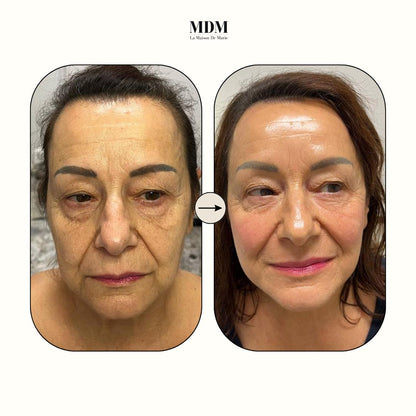 Peeling viso Enzimatico (metodo Marie)